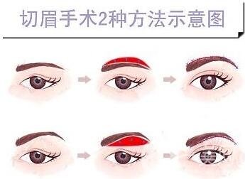 切眉除皺術(shù)要多少錢(qián)?*果好嗎?