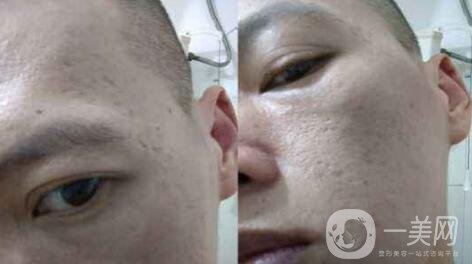 自體細胞注射去痘坑