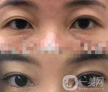 雙眼皮手術(shù)
