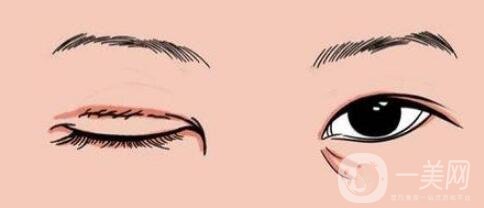 雙眼皮手術(shù)