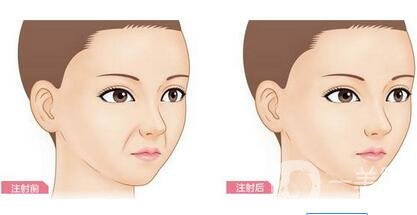 注射豐鼻唇溝*果*嗎？能立馬*果嗎？