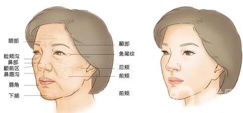 注射豐鼻唇溝*果*嗎？能立馬*果嗎？