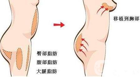 自身脂肪移植隆胸術(shù)有沒有副作用？