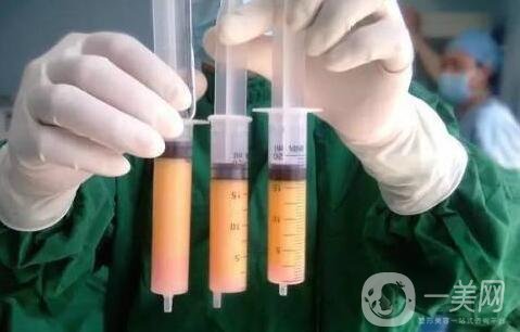 全身抽脂手術(shù)要多長(zhǎng)時(shí)間，會(huì)全麻嗎?