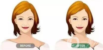 提升除皺手術(shù)多少錢?價(jià)格會(huì)有變化嗎