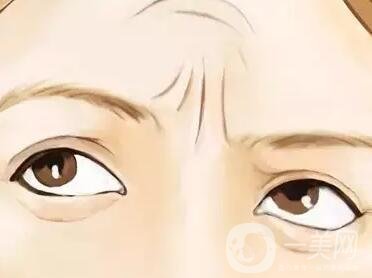 提升除皺手術(shù)多少錢?價(jià)格會(huì)有變化嗎