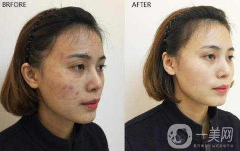 像素激光祛痘印