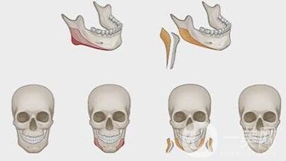 磨下頜角價格是不是很貴？一般要多少錢？