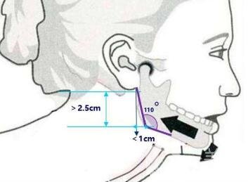 磨下頜角價格是不是很貴？一般要多少錢？