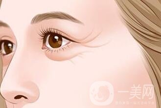 去除魚尾紋的方法有哪些？哪種方法比較好？