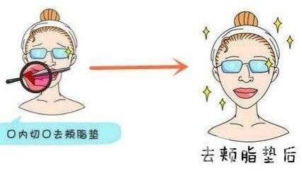 去頰脂墊價(jià)格貴嗎？大概價(jià)位是多少？