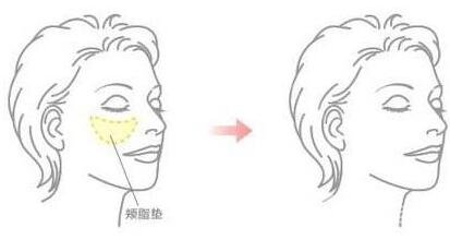 去頰脂墊價(jià)格貴嗎？大概價(jià)位是多少？