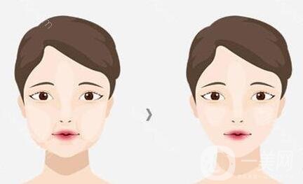 去頰脂墊價(jià)格貴嗎？大概價(jià)位是多少？