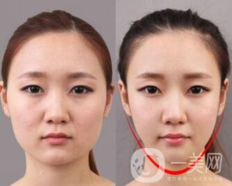 去頰脂墊有副作用嗎？術(shù)后如何護(hù)理可以減小副作用？