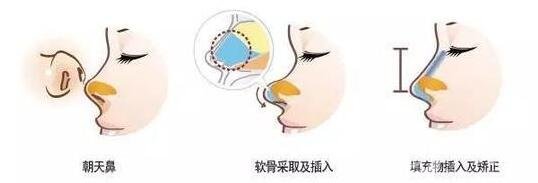 朝天鼻整形價格貴嗎?大概要多少錢?