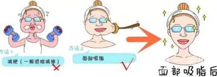 抽脂瘦臉手術(shù)過(guò)程*嗎?術(shù)后*果*嗎?