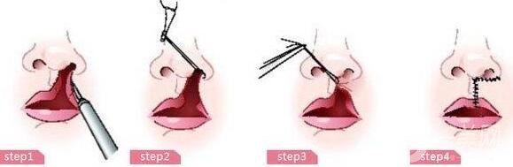 唇裂手術(shù)多少錢?一般唇裂手術(shù)要多少錢?