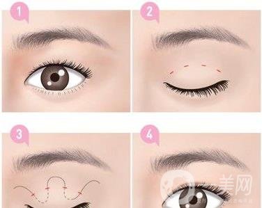 *需要拆線嗎？多長時(shí)間可以碰水？