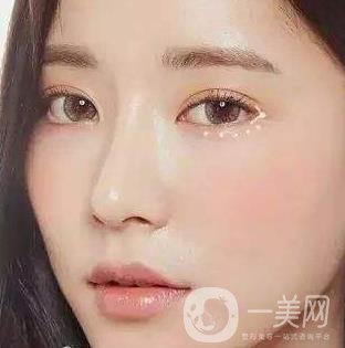 *需要拆線嗎？多長時(shí)間可以碰水？