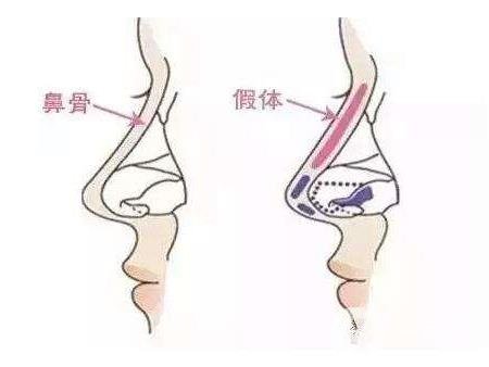 假體隆鼻整型術(shù)術(shù)前準(zhǔn)備有哪些？