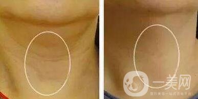 頸部除皺提升術(shù)