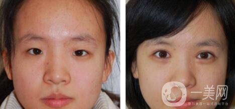 開眼角手術(shù)