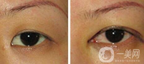 開眼角手術(shù)