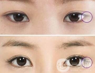 開眼角手術(shù)