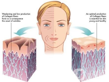 冰電波拉皮除皺*果如何？有哪些優(yōu)點(diǎn)？