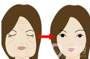 冰電波拉皮除皺*果如何？有哪些優(yōu)點(diǎn)？