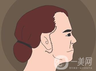 冰電波拉皮除皺*果如何？有哪些優(yōu)點(diǎn)？