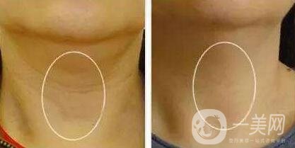 冰電波拉皮除皺*果如何？有哪些優(yōu)點(diǎn)？