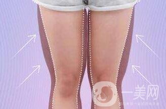 大腿環(huán)形吸脂多久恢復(fù)？會有疤嗎？