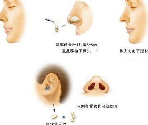 鼻尖美容術(shù)是怎樣做的?詳細(xì)解析公布