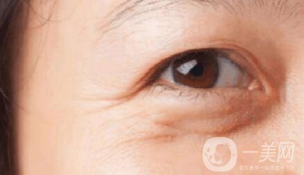 注射去魚(yú)尾紋