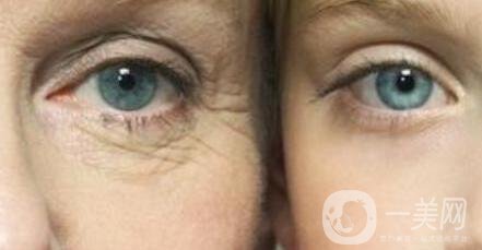 注射去魚(yú)尾紋