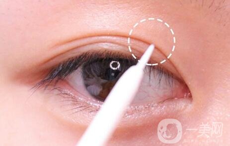 做雙眼皮手術過程