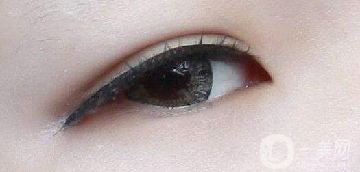 做雙眼皮手術過程