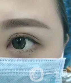 做雙眼皮手術過程