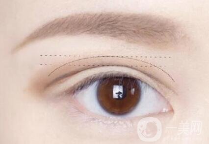 做雙眼皮手術過程