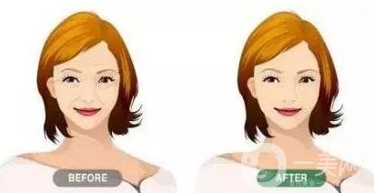 瑞蘭玻尿酸注射除皺價格要多少錢？