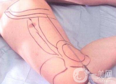 吸脂減肥*嗎？有危險嗎？