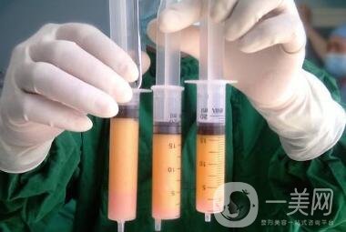 吸脂減肥*嗎？有危險嗎？