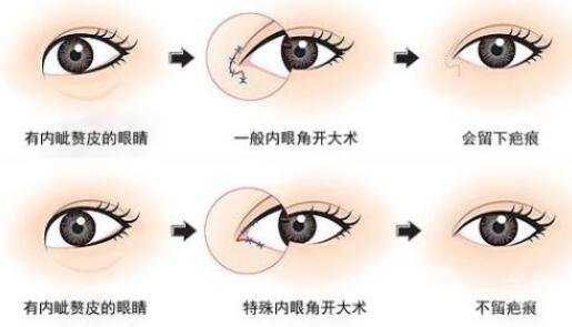 開(kāi)內(nèi)眼角