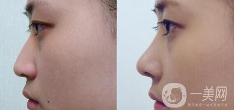 隆鼻手術