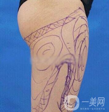 大腿部吸脂塑形術(shù)后護(hù)理的那些事兒