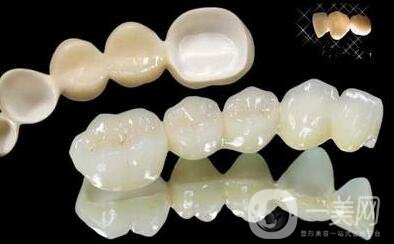 貴金屬烤瓷牙有哪些種類？