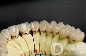 貴金屬烤瓷牙有哪些種類？