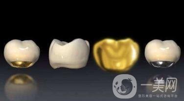 貴金屬烤瓷牙有哪些種類？