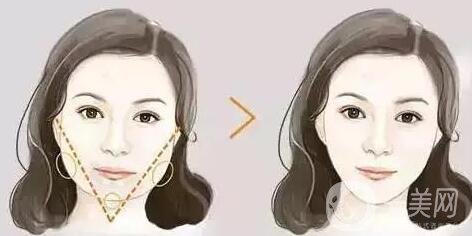 去頰脂墊價格貴不貴?收費情況說明